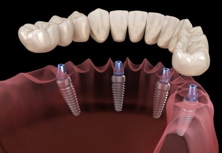 Full Mouth Dental Implant in Faridabad