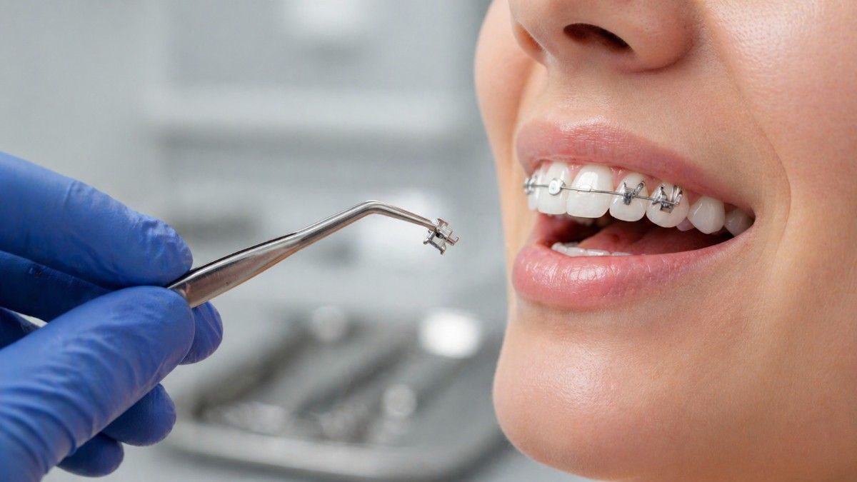 Dental Clips for Teeth